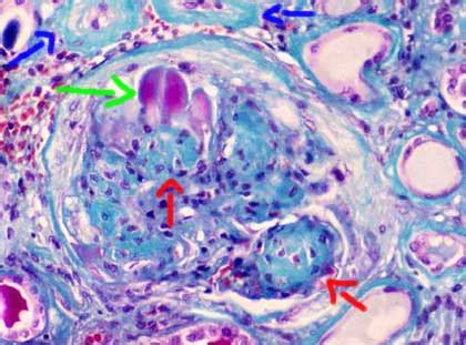 Pathology Outlines - Diabetic glomerulosclerosis