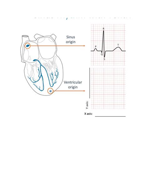 Sinus rhythm with ventricular ectopics The sinus | Chegg.com