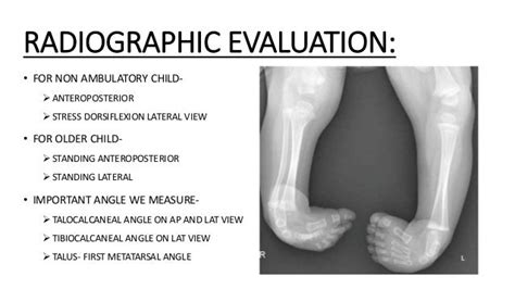 Congenital talipes equinovarus (club foot/ctev) ppt by Dr Pratik