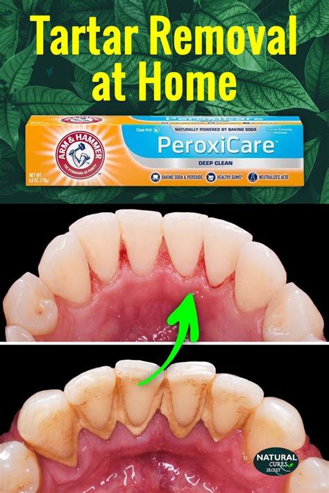 Dental Hygiene: Learn how to remove tartar from teeth without dentist, tartar removal at home ...