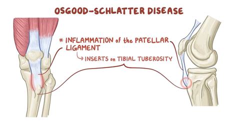 Osgood-Schlatter disease (traction apophysitis): | Osmosis