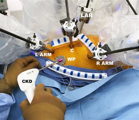 Minimally Invasive and Robot-Assisted Mitral Valve Surgery | Adult and ...