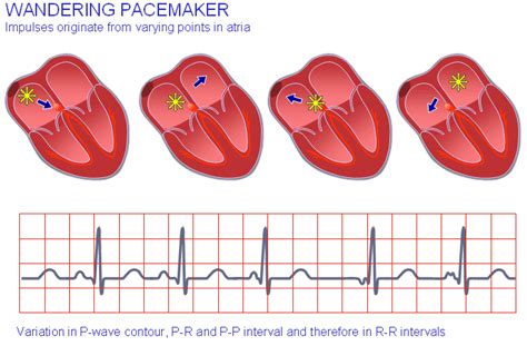 2.E Wandering pacemaker. | Download Scientific Diagram