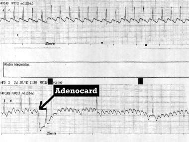 What is the role of vagal maneuvers in the diagnosis of atrial flutter (AFL)?