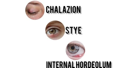 Chalazion vs External Hordeolum (Stye) vs Internal Hordeolum ...