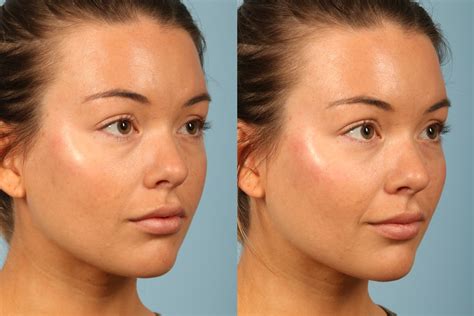 Contouring with Makeup or with Fillers? | Kavali Plastic Surgery and Skin Renewal Center