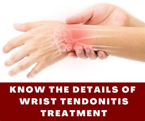 Know The Details Of Wrist Tendonitis Treatment - Buildingbeast