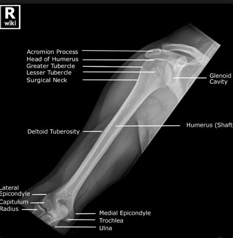 Humerus XRAY | Medical radiography, Radiology student, Radiology