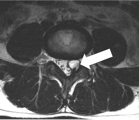 Synovial Cyst Lumbar Mri