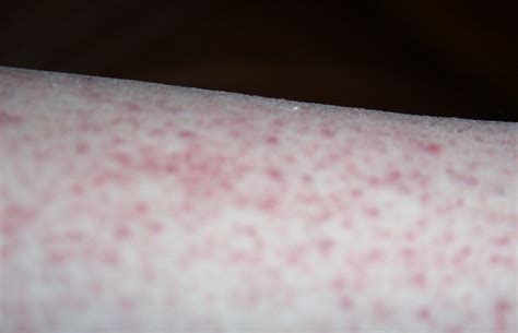 skin rash 2 | Skin rash due to taking Sulfasalazine for thre… | Flickr