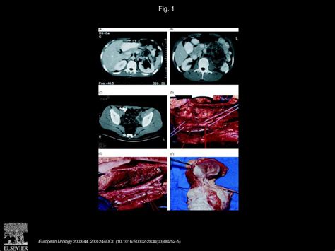 Surgery in Metastatic Testicular Cancer - ppt download