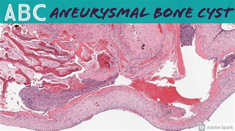 Aneurysmal Bone Cyst Jaw Histology