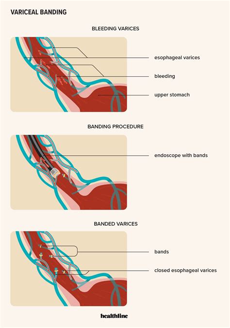 Variceal Banding: Procedure, Recovery Time, Outlook, and More