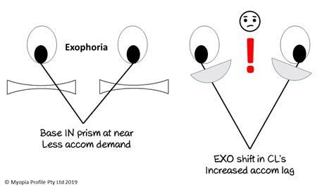 What About The Exophores? - Myopia Profile Binocular Vision Myopia Control