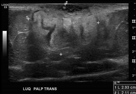 Dermatofibrosarcoma protuberans | Radiology Case | Radiopaedia.org