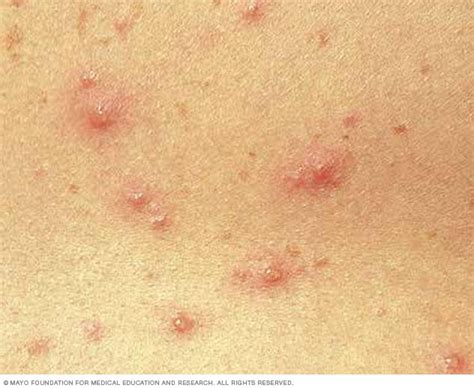 Chickenpox - Symptoms and causes - Mayo Clinic