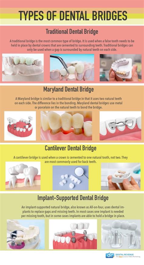 Cantilever Dental Bridge