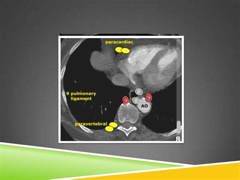 CT ANATOMY OF NORMAL MEDIASTINUM MADE EASY