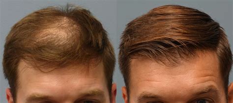 Before and After Neograft Hair Transplant - Hair Restoration Savannah