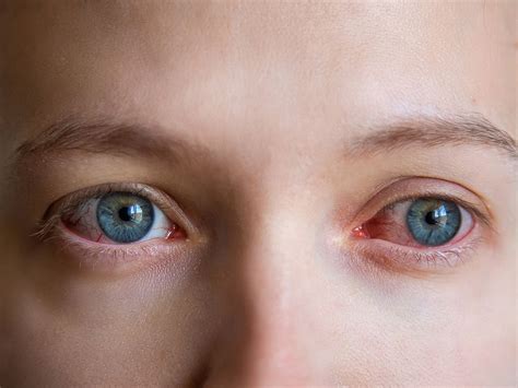 Allergic Conjunctivitis - Liba