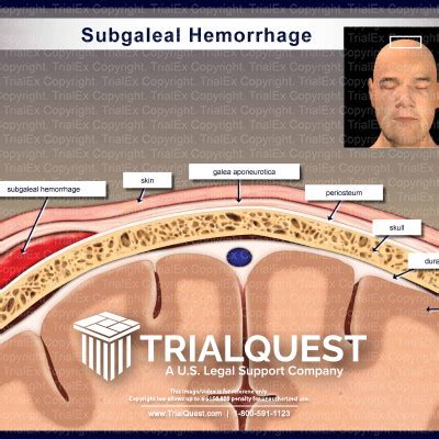 Medical Legal Exhibits - Legal Animations & Trial Graphics - Tria...