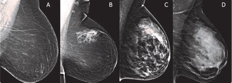 What Causes Scattered Fibroglandular Densities | Renew Physical Therapy