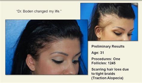 Traction Alopecia Hair Loss | Balding Edges | Hartford, CT