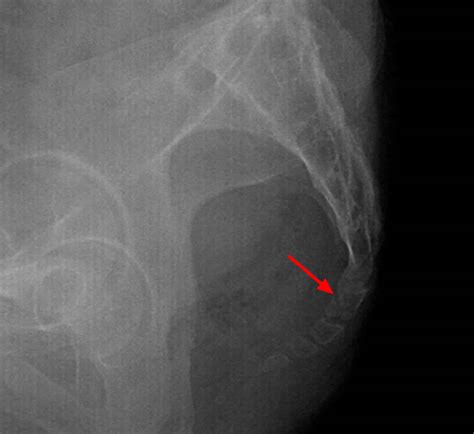 Coccyx bone anatomy, tailbone pain, fractured tailbone & treatment