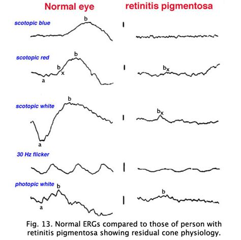 ELECTRORETINOGRAM BASICS PDF