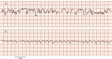 Sinusoidal fetal heart rate