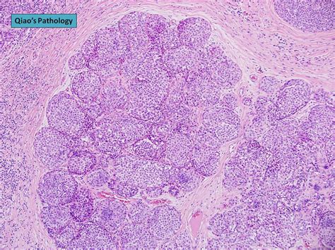 Qiao's Pathology: Lobular Carcinoma In Situ (LCIS) | Flickr