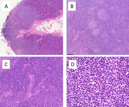 Lymph node biopsy, H&E stains. (A) On low magnification, the lymph node ...