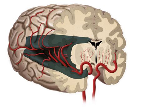 Hemispherectomy - Pediatric Neurosurgery | UCLA Health