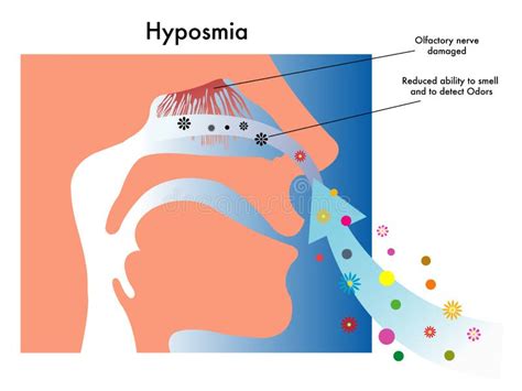 Hyposmia stock photo. Image of receptors, alteration - 38841150