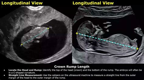 How To Measure Crown Rump Length (CRL) On Ultrasound | Intrauterine ...