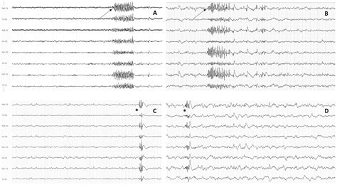 Biomedicines | Free Full-Text | EEG Markers of Treatment Resistance in ...