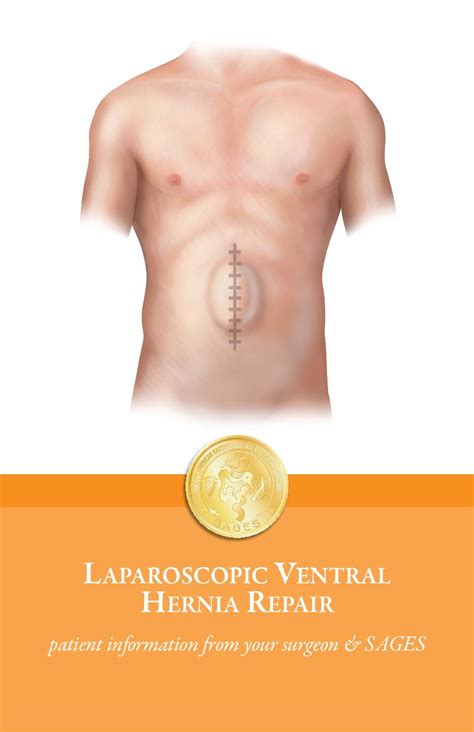 Laparoscopic Ventral Hernia Repair Information from SAGES