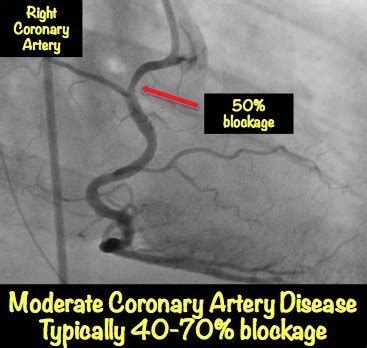 Heart Blockage: Explained with Pictures • MyHeart