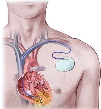 Heart Block Treatment: Tradition and Technology - HEALTH LIFESTYLE