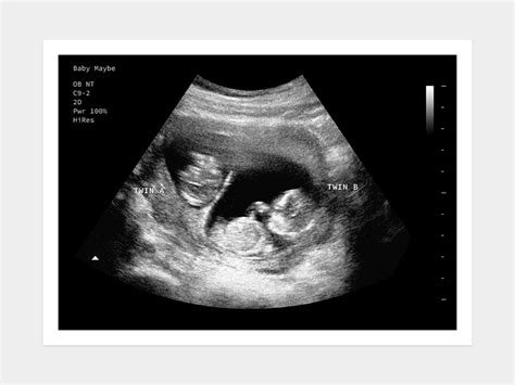 12 Weeks Twins | Fake Ultrasound w/ Instant Download!