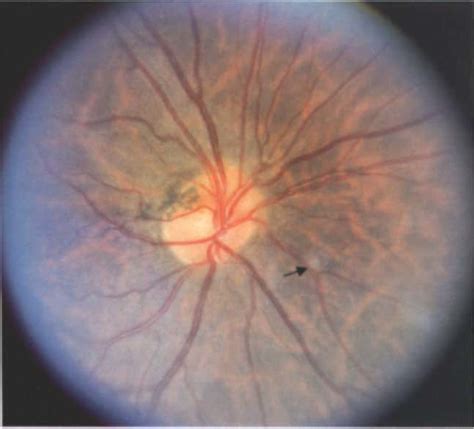 Case 1. Fundus appearance. Right optic disc is mildly dysplastic (a). A ...