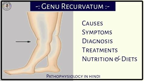 पैरो का आगे कि ओर मुडना | What is Genu Recurvatum, causes, treatment pathophysiology in hindi ...