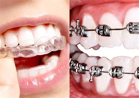 ¿Ortodoncia invisible o brackets u ortodoncia mixta?