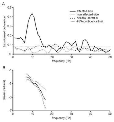 What is Electromyography (EMG) Test? | AOA Texas