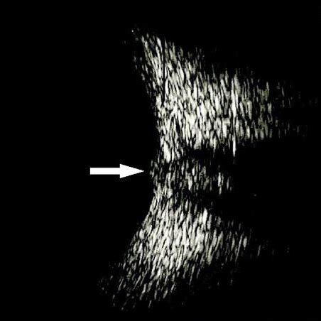 Optic nerve B-scan ultrasound in a child in which the optic nerve head... | Download Scientific ...