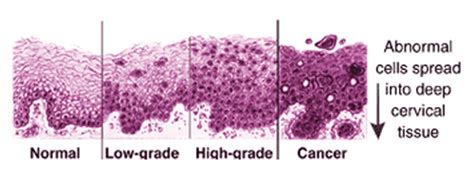 PAP Smear Screening - The CRUDEM Foundation, Inc