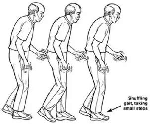 Parkinsonian Gait : Gait Training Exercise to Improve Gait Cycle