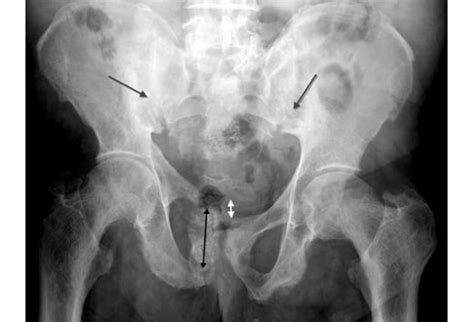 Pelvic Fracture X Ray