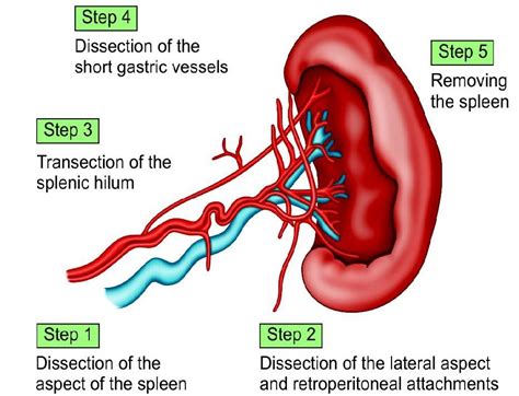 Laparoscopic Splenectomy Surgical Technique