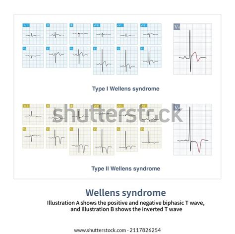 24 Wellens' Syndrome Images, Stock Photos, 3D objects, & Vectors ...